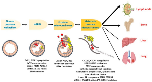 Diagram of prostate cancer Description automatically generated