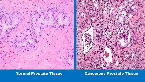 Study Suggests a Healthy Diet May Help Keep Low Grade Prostate Cancer From Progressing to More Dangerous States During Active Surveillance | Johns Hopkins Medicine